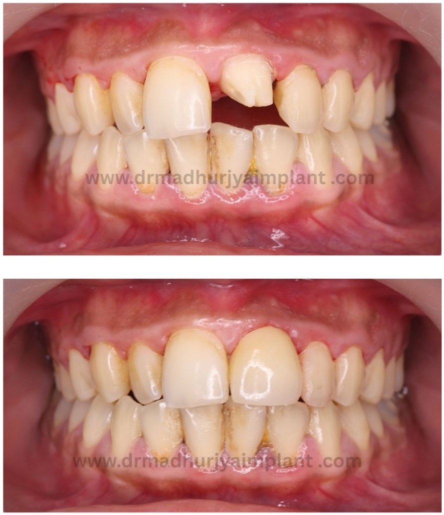 Before and after implant treatment — single anterior gap closed