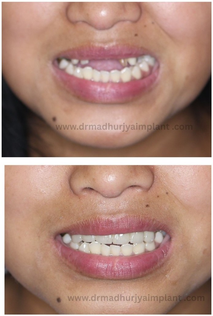 Before and after implant treatment — front teeth restored