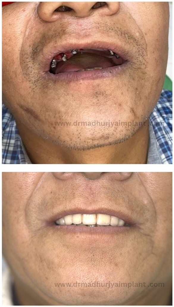 Before and after implant treatment — upper arch rehabilitation
