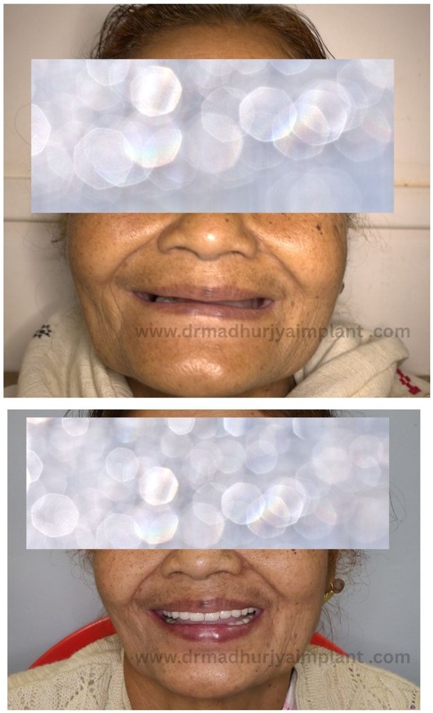 Before and after implant treatment — full-arch fixed prosthesis