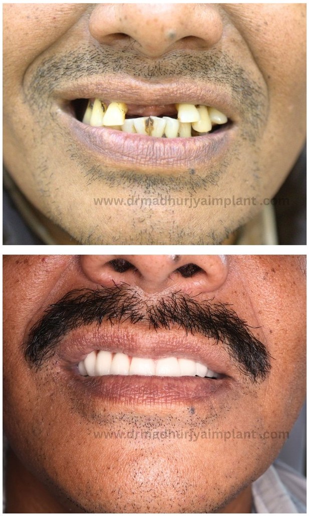 Before and after implant treatment — missing uppers replaced