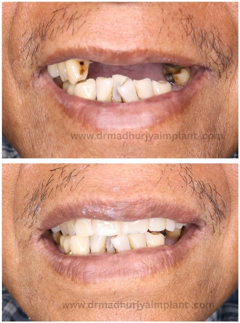 Before and after implant treatment — severely worn dentition