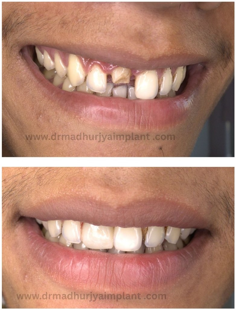 Before and after implant treatment — multiple teeth restored