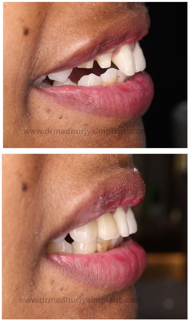 Before and after implant treatment — spacing and alignment