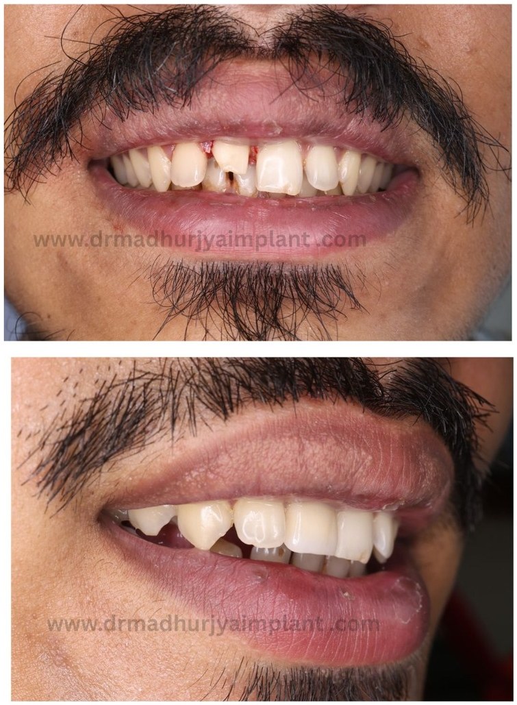 Before and after implant treatment — fixed teeth on implants